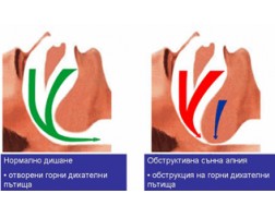Синдром на обструктивна сънна апнея